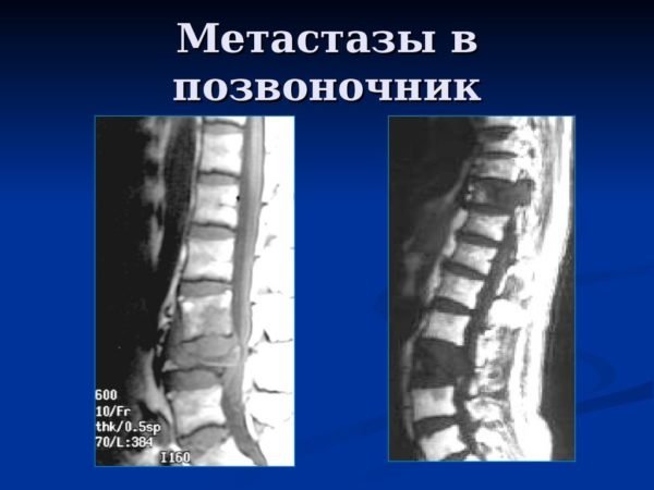 Метастазы в позвоночник