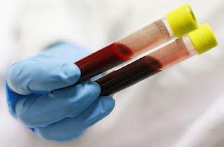  Alt and AST blood test transcript