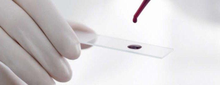 biochemical analysis of blood transcript of Alt AST
