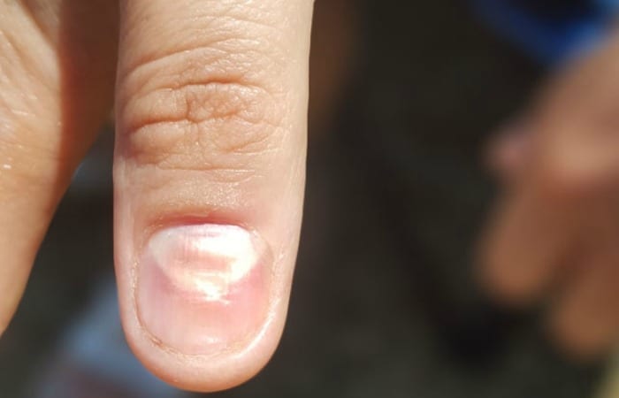 ridges in your fingernails could be a sign of multiple issues, and you should see a doctor