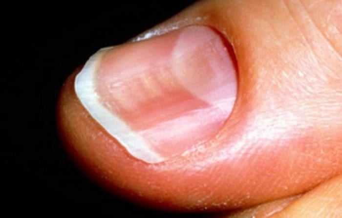 curved fingernails could be a sign of serious disease