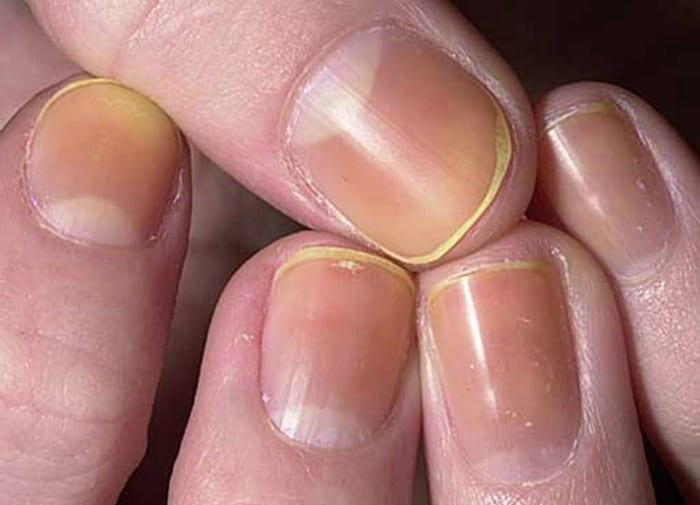 yellow discolored nails are common and could be from nail polish stains or smoking