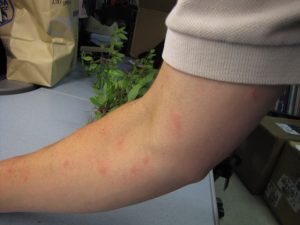 mosquito and insect bites