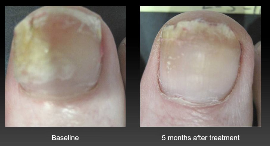 nail treatment for fungus in Seattle