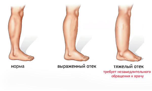 Стадии развития отека ног