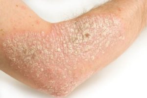 Picture of Skin Rashes on Arm