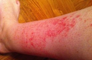 Red Rash on Legs