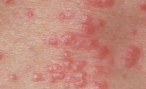Red Bumpy Rash on Scrotum - STD