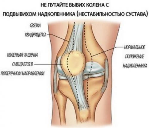 Как лечить суставы колен. Эффективные средства от боли в коленном суставе
