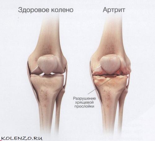 Как лечить суставы колен. Эффективные средства от боли в коленном суставе