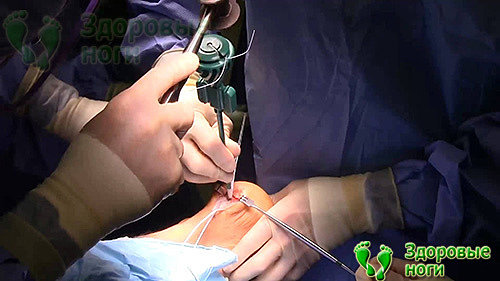 Хирургическим путем лечение пяточной шпоры проводится тогда, когда другие методы бессильны
